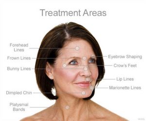 Botox Treatment areas