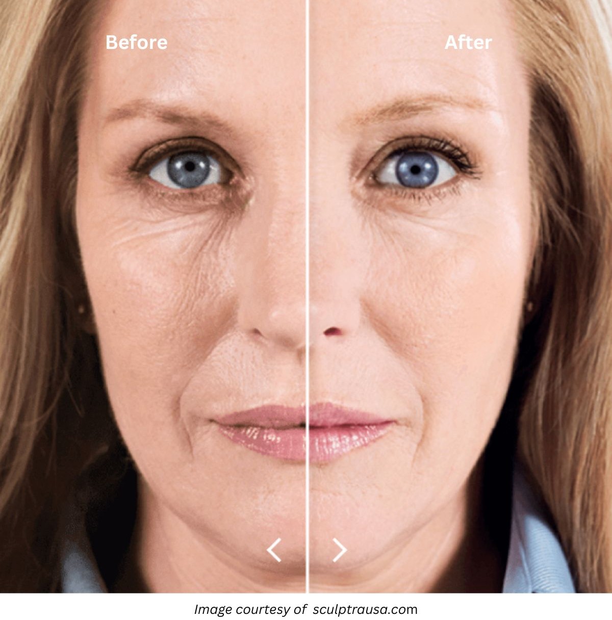 bio-stimulating-fillers-plano_sectImg1 - 2 bio-stimulating-fillers-plano_sectImg1 - 2